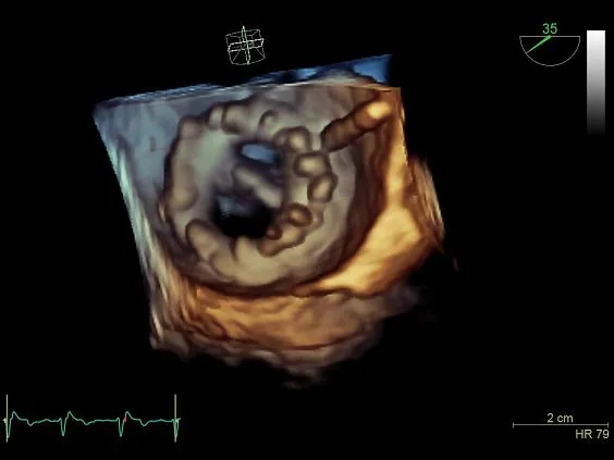 Клинические изображения GE Vivid S70 УЗИ аппарат