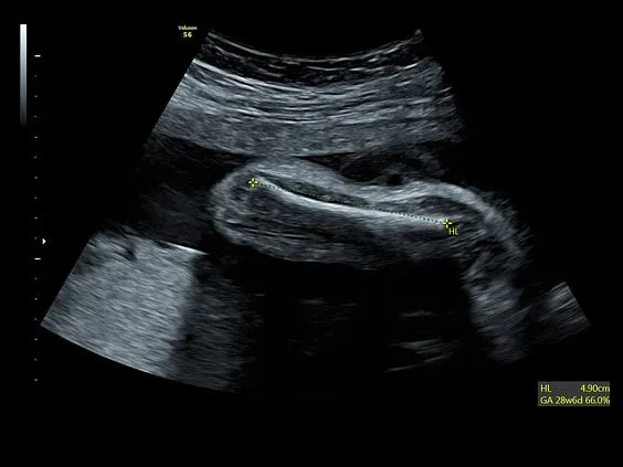 Клинические изображения GE Voluson S6 аппарат УЗИ