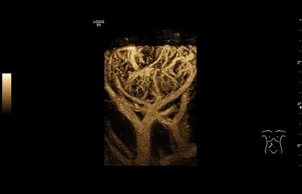 Клинические изображения УЗИ аппарат GE Healthcare Logiq E9 XDclear