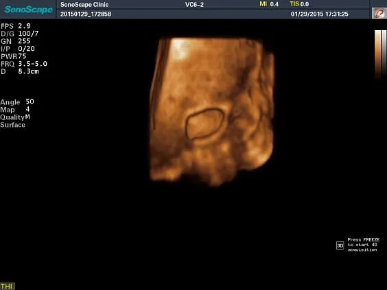 Клинические изображения Sonoscape S8 Exp ультразвуковой аппарат