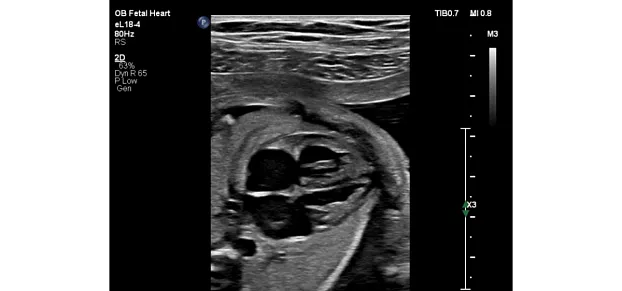 Клинические изображения Philips EPIQ CVx ультразвуковой аппарат