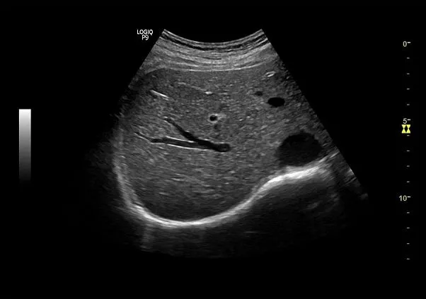 Клинические изображения GE Logiq P9 ультразвуковая диагностическая система