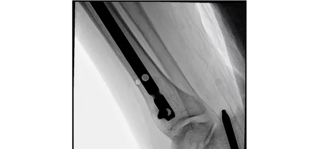 Клинические изображения С-дуга Philips Zenition 30