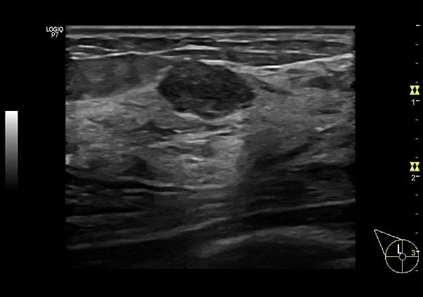 Клинические изображения Logiq P7 УЗИ аппарат GE