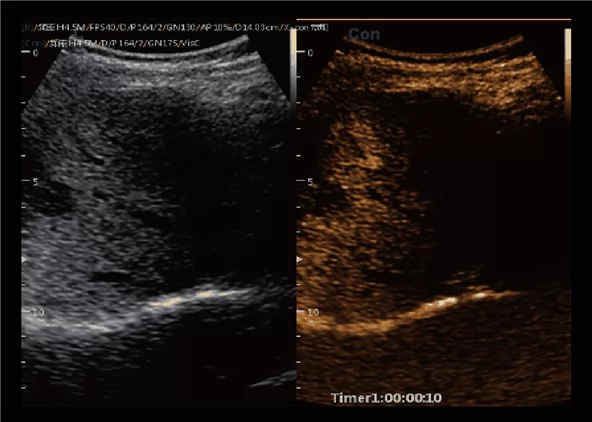 Клинические изображения УЗИ аппарат Chison CBit 9
