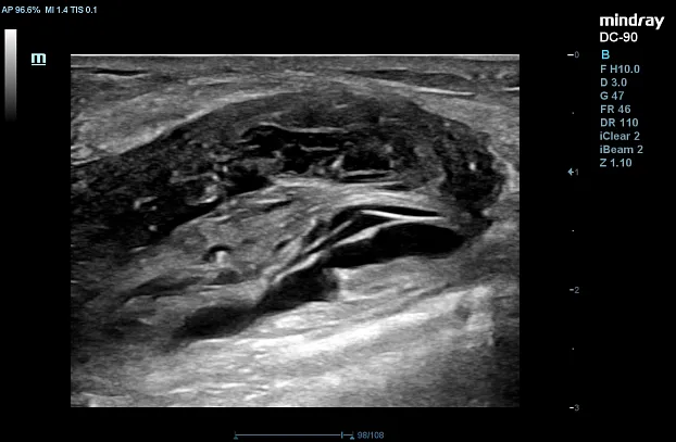 Клинические изображения УЗИ аппарат Mindray DC-90 X-Insight
