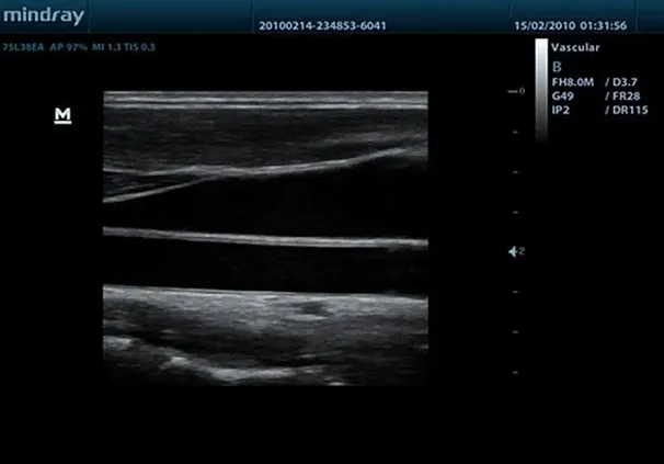 Клинические изображения УЗИ аппарат Mindray DC-7