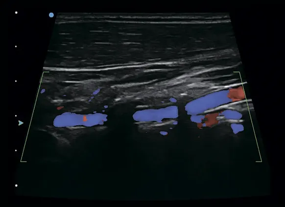 Клинические изображения SIUI Apogee 1100 УЗИ аппарат портативный