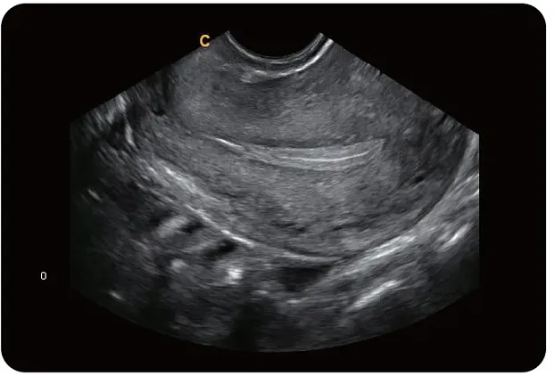 Клинические изображения УЗИ аппарат Chison Qbit 9 New Matrix