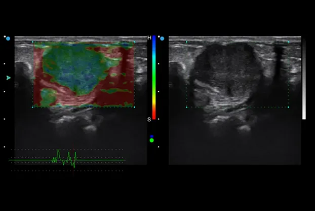 Клинические изображения SIUI Apogee 5300 аппарат УЗИ