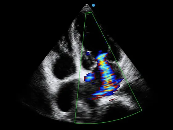 Клинические изображения Аппарат УЗИ SIUI Apogee 5500