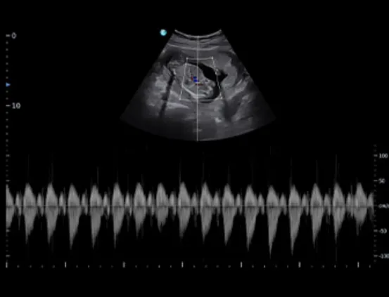 Клинические изображения УЗИ аппарат Chison SonoTouch 50 (Sonoair) портативный