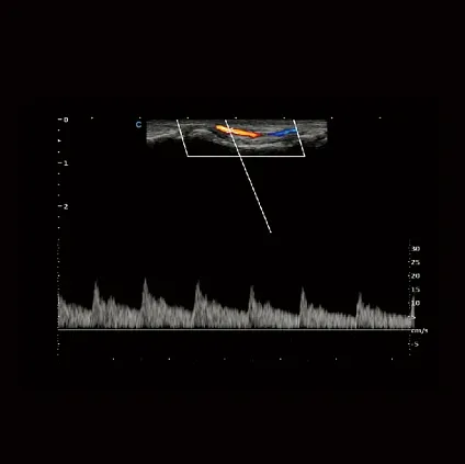 Клинические изображения Chison Qbit 12 ультразвуковой аппарат