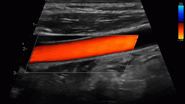 Клинические изображения Ультразвуковая диагностическая система GE HealthCare Vivid iQ портативная