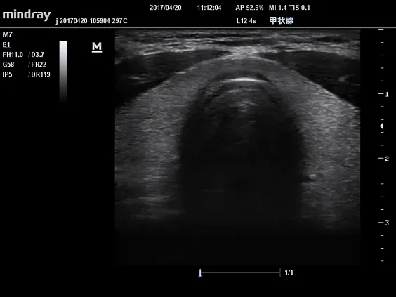 Клинические изображения УЗИ аппарат Mindray M7 Premium портативный