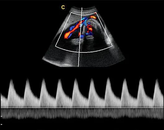 Клинические изображения УЗИ аппарат Chison Qbit 8