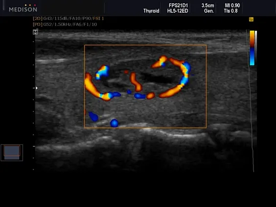 Клинические изображения Samsung Medison SonoAce R7 УЗИ аппарат