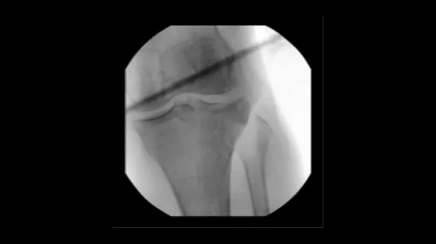 Коленный сустав, переднезадняя проекция, 21 см