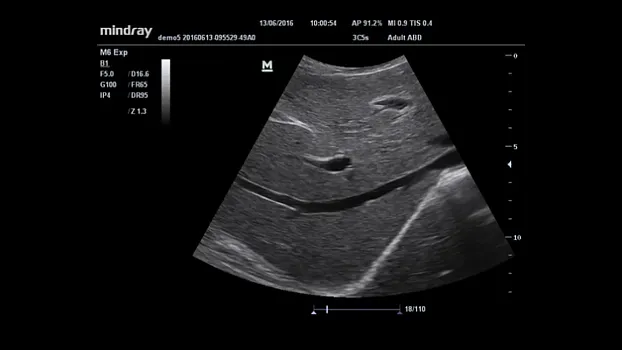 Клинические изображения УЗИ аппарат Mindray M6 портативный