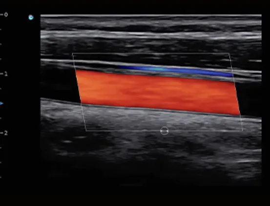 Клинические изображения УЗИ аппарат Chison SonoTouch 50 (Sonoair) портативный