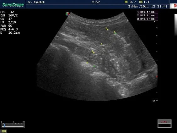 Клинические изображения Sonoscape S35 ультразвуковой аппарат