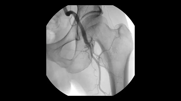 Ангиография бедренной артерии, 21 см