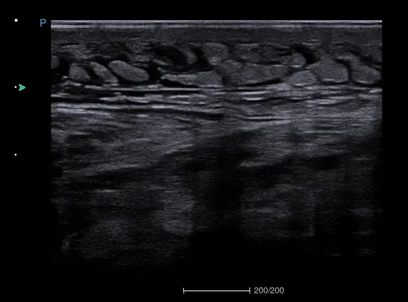 Клинические изображения SIUI Apogee 6500 ультразвуковой аппарат