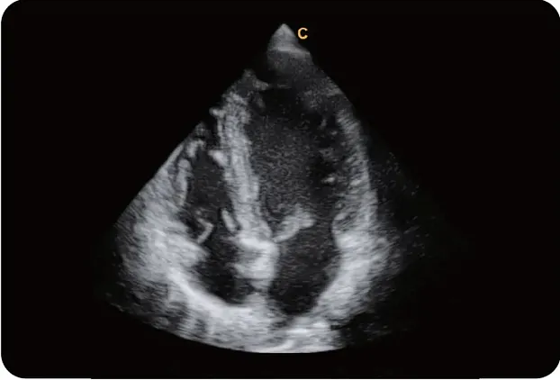 Клинические изображения УЗИ аппарат Chison Qbit 9 New Matrix