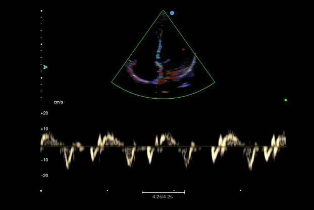 Клинические изображения SIUI Apogee 5300 аппарат УЗИ