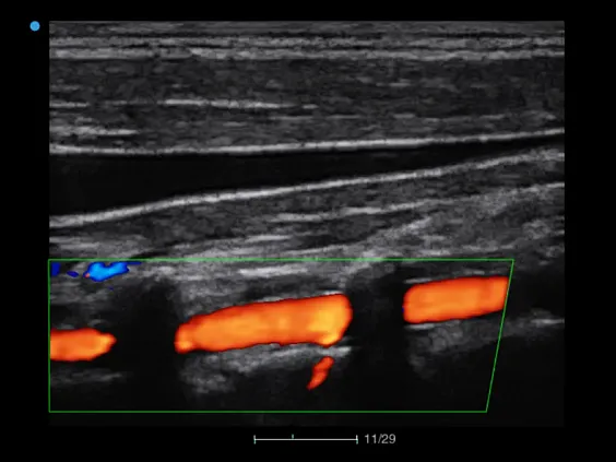 Клинические изображения Аппарат УЗИ SIUI Apogee 3500