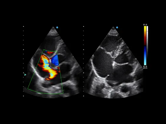 Клинические изображения Аппарат УЗИ SIUI Apogee 3500