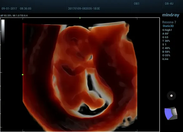 Клинические изображения УЗИ аппарат Mindray Resona 7s