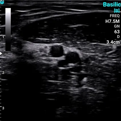 Клинические изображения Chison Sonotouch 30 (Sonoeye) портативный УЗИ аппарат