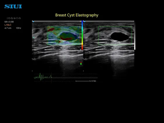 Клинические изображения SIUI Apogee 6500 ультразвуковой аппарат