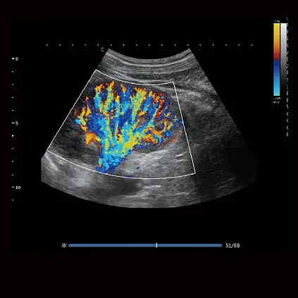 Клинические изображения Chison Qbit 12 ультразвуковой аппарат