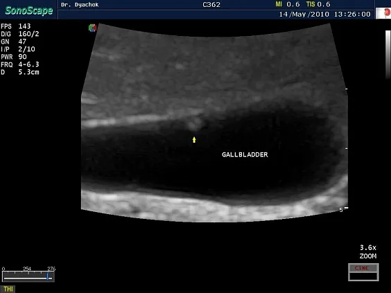 Клинические изображения Sonoscape S40 Exp ультразвуковой аппарат
