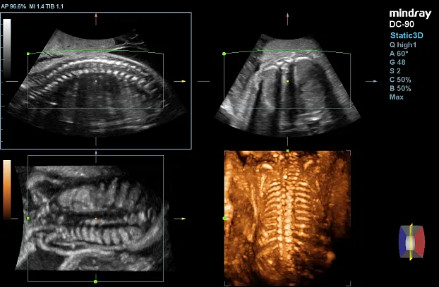 Клинические изображения УЗИ аппарат Mindray DC-90 X-Insight