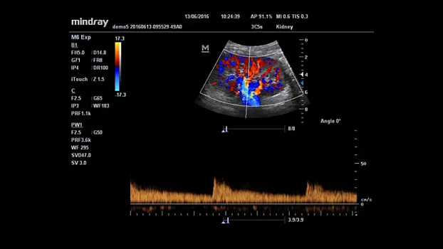 Клинические изображения УЗИ аппарат Mindray M6 портативный