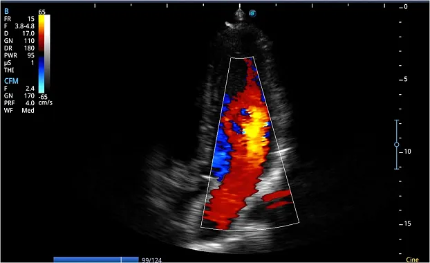 Клинические изображения Sonoscape E3 ультразвуковой аппарат