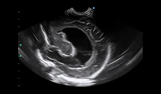 Клинические изображения SIUI Apogee 6500 ультразвуковой аппарат