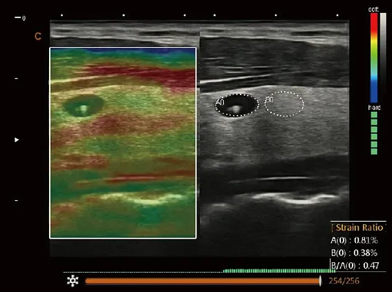 Клинические изображения УЗИ аппарат Chison SonoTouch 80 Expert портативный