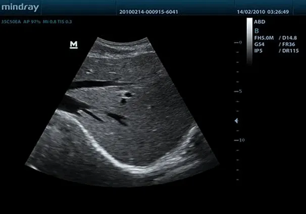 Клинические изображения УЗИ аппарат Mindray DC-7