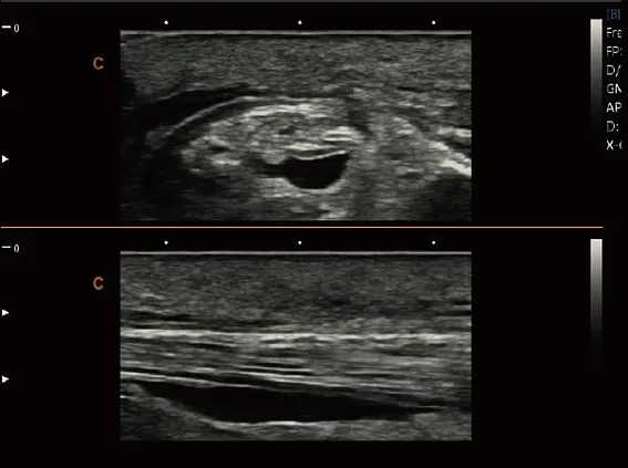 Клинические изображения УЗИ аппарат Chison SonoTouch 80 Expert портативный
