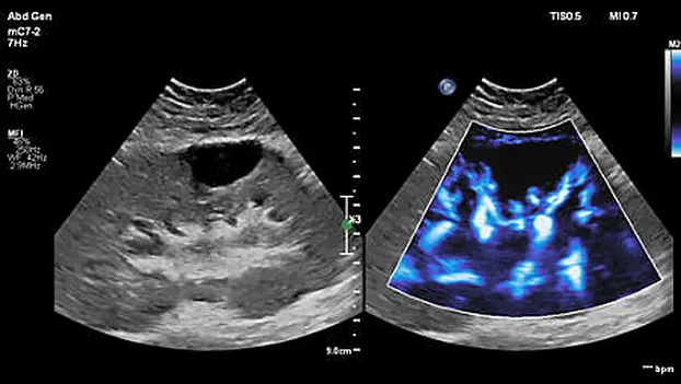 Клинические изображения Philips EPIQ Elite ультразвуковой аппарат