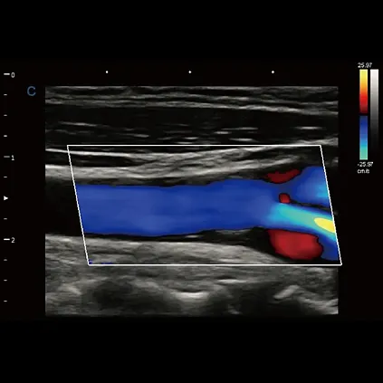 Клинические изображения УЗИ аппарат Chison Qbit 10