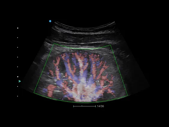 Клинические изображения Аппарат УЗИ SIUI Apogee 3500