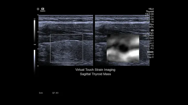 Клинические изображения Siemens Sequoia аппарат УЗИ