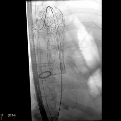 Клинические изображения Philips Zenition 70 C-дуга