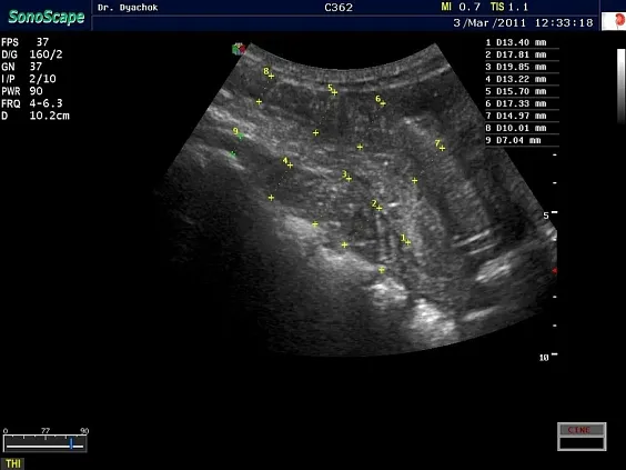 Клинические изображения Sonoscape S15 ультразвуковой аппарат