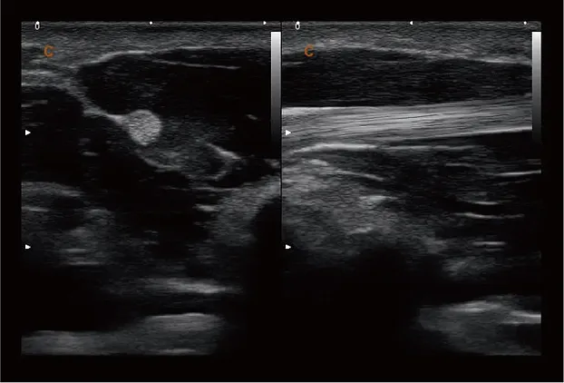 Клинические изображения УЗИ аппарат Chison SonoTouch 60 портативный